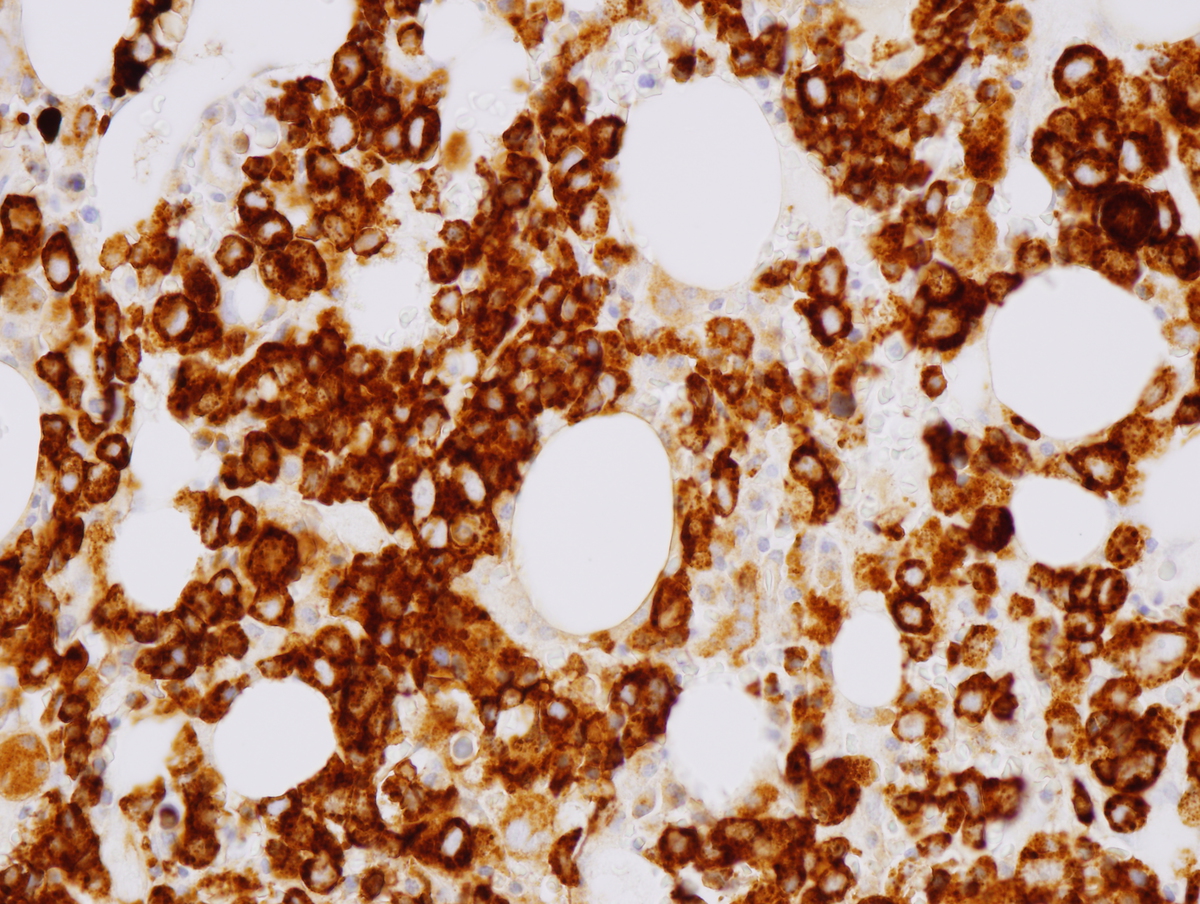 Bone marrow core biopsy CD71 400x